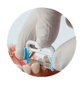 StripFix no handle IPR strips